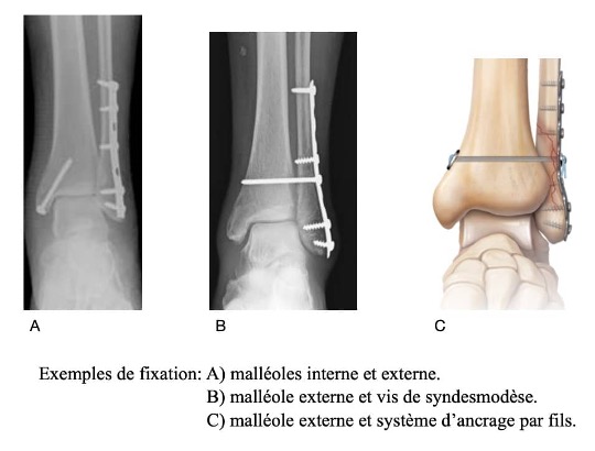 Les fractures de la cheville - Dr Mehdi Omar KRIMECH